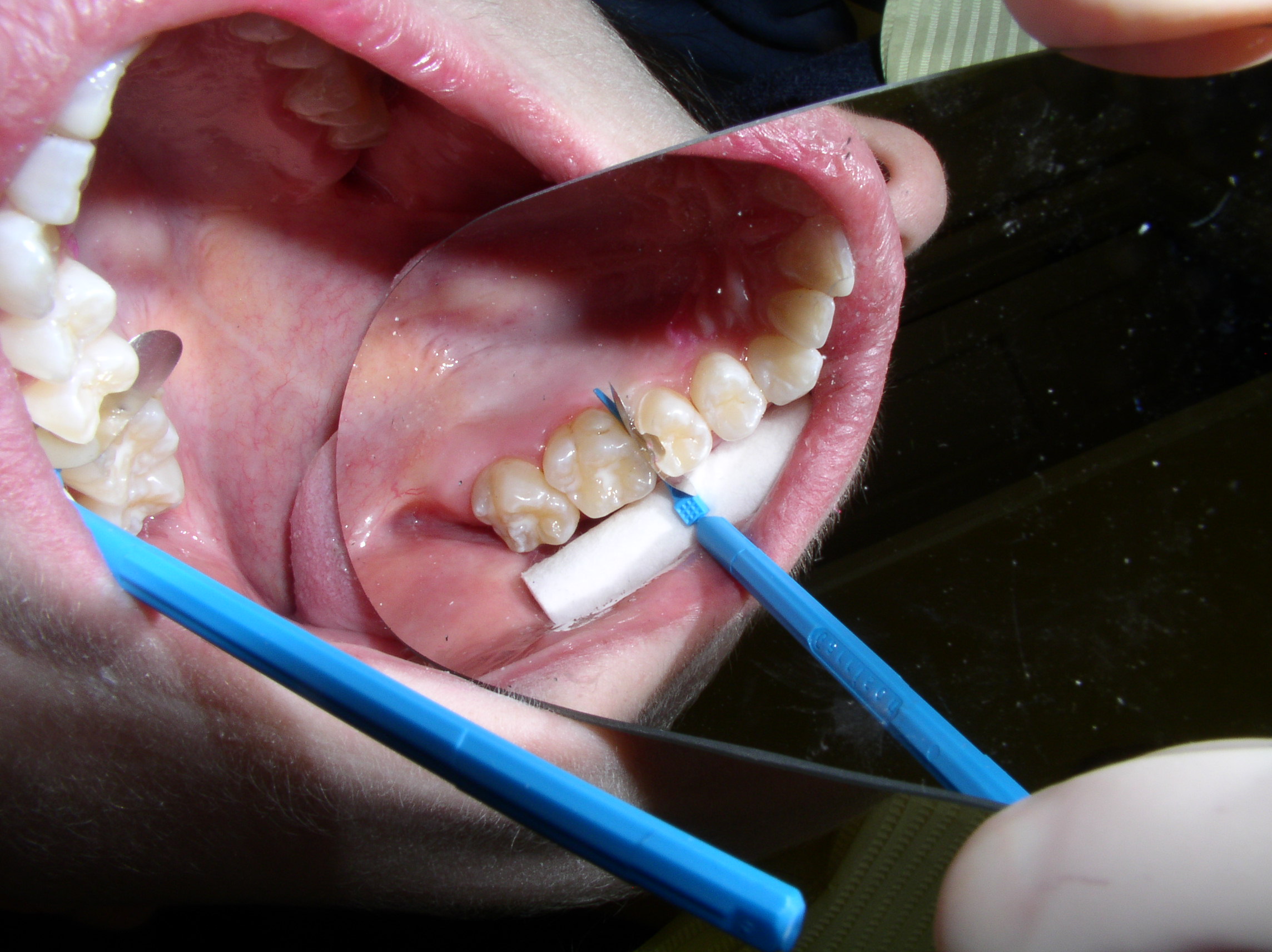 Coffret Wedge Wands® Garrison Dental